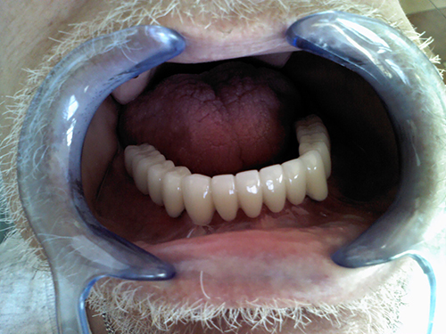 Tijuana Dentist Four Implants In - Before